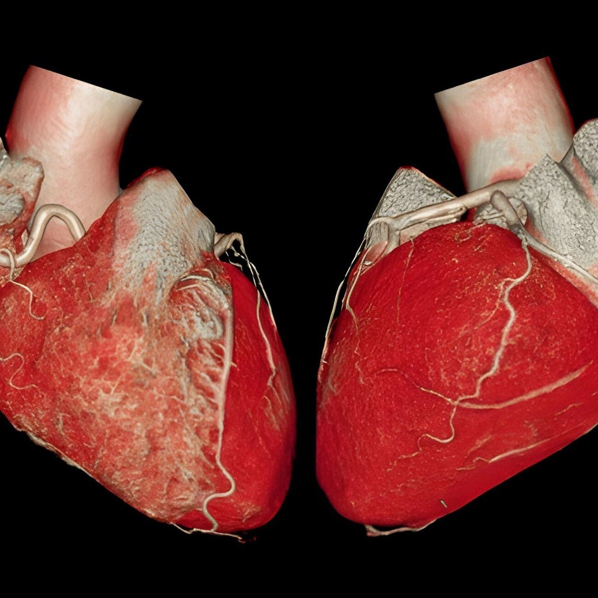 Volume-rendered cardiac CT angiography showing the heart and coronary arteries
                  from two viewing angles.