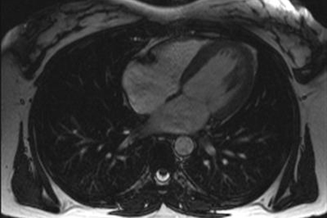 Axial cardiac magnetic resonance image through the heart.