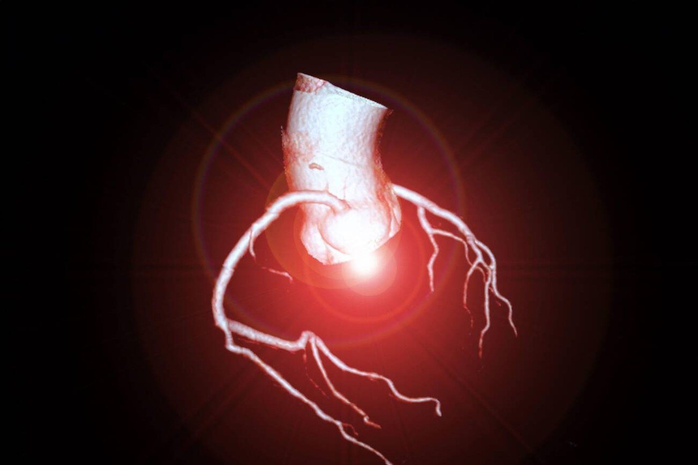 Three-dimensional reconstruction of the coronary arteries from CT angiography.